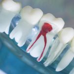 endodontie zahnarzt leipzig